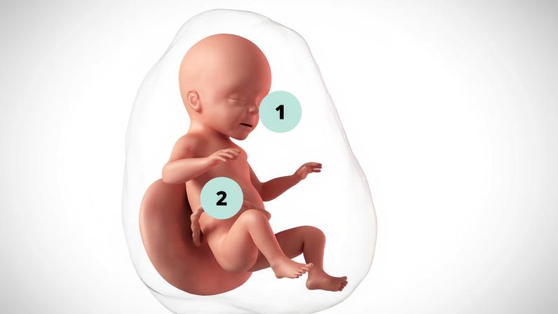 Completos com pálpebras, cílios e sobrancelhas, os olhos do feto começam agora a abrir e, em breve, o bebê conseguirá piscar; 2. O corpo do feto já produz melanina, a pigmentação que dá o tom da pele, dos olhos e dos cabelos e que serve de proteção contra a ação dos raios solares — Foto: Getty Images