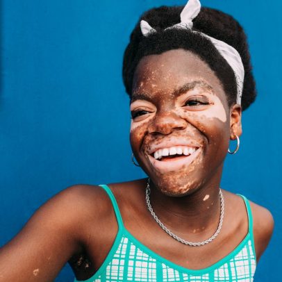 Vitiligo: entenda causas, tratamentos e como lidar com o estigma da condição de pele