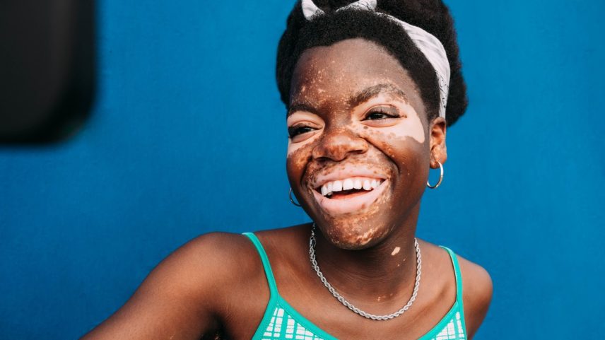 Vitiligo: o que é, causas, tratamento e como combater o estigma da condição de pele (Foto: Getty Images)