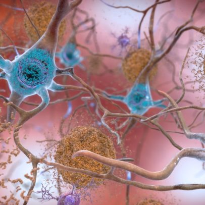 Caso mais jovem de Alzheimer é registrado em paciente com menos de 20 anos