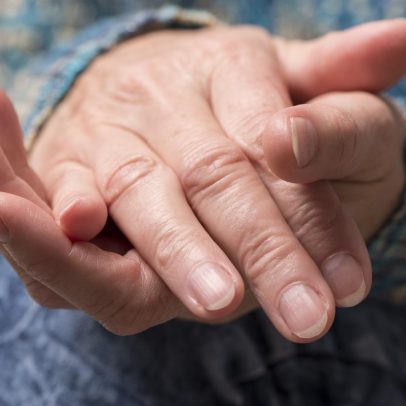 Estrias nas unhas: entenda as causas e quando buscar ajuda médica
