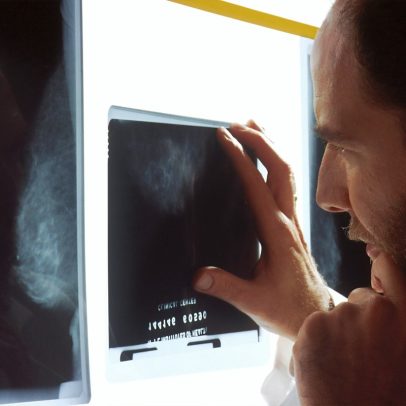 Cresce alerta global sobre aumento de câncer em pacientes jovens