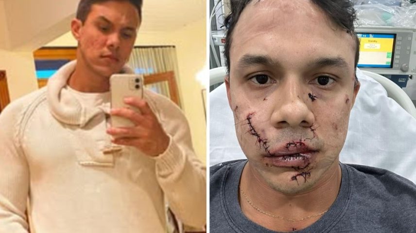 O personal Thiago Medeiros Ribeiro Mendes, em foto de 2022, e depois de levar 45 pontos no rosto após agressões com um copo de vidro em bar de Águas de Lindóia (SP) (Foto: Arquivo pessoal)