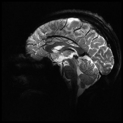Mulher morre após aneurisma cerebral durante relação sexual; entenda o caso raro