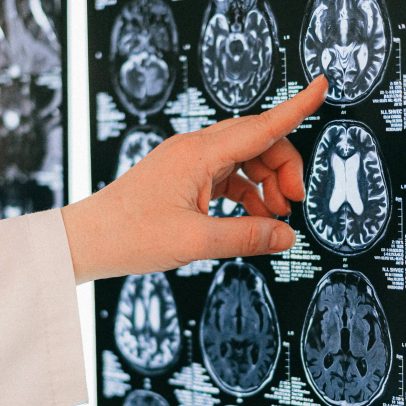 Pesquisa revela que estruturas cerebrais não causam psicopatia diretamente