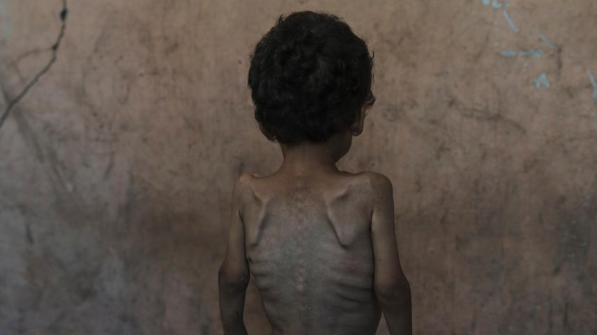 Yazan Abu Ful, de 2 anos, desnutrido, posa para uma foto na casa de sua família no campo de refugiados de Shati, na Cidade de Gaza, na quarta-feira, 23 de julho de 2025 (Foto: Jehad Alshrafi/AP)