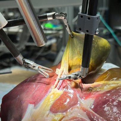 Máquina cirúrgica demonstra potencial para substituir cirurgiões humanos no futuro