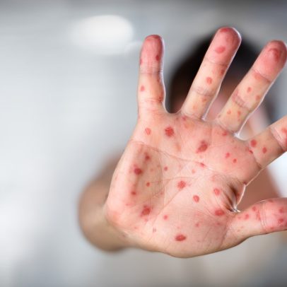 Casos de sarampo nos EUA alcançam maior nível em 25 anos de erradicação
