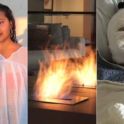 Lareira a álcool causa explosão e deixa jovem de 18 anos com rosto desfigurado