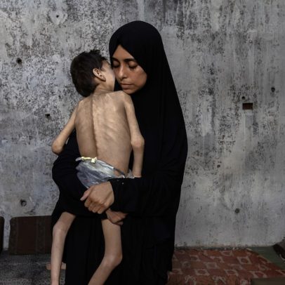 Enfermeiros em Gaza enfrentam a fome em meio à crise humanitária crescente