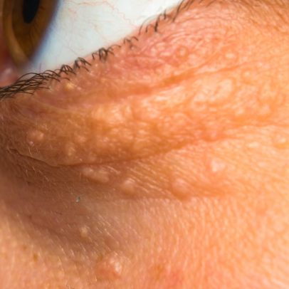 Colesterol alto: identifique os sintomas e saiba quando buscar ajuda médica