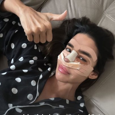 Kerline revela rosto inchado após cirurgia e rotina intensa de cuidados nasais