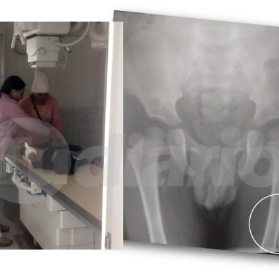 Médicos encontram agulhas na coxa de menino de 4 anos com dor na perna