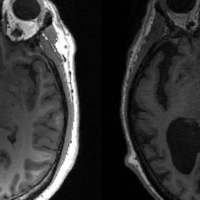 Remédio inovador contra Alzheimer avança para fase final de testes clínicos