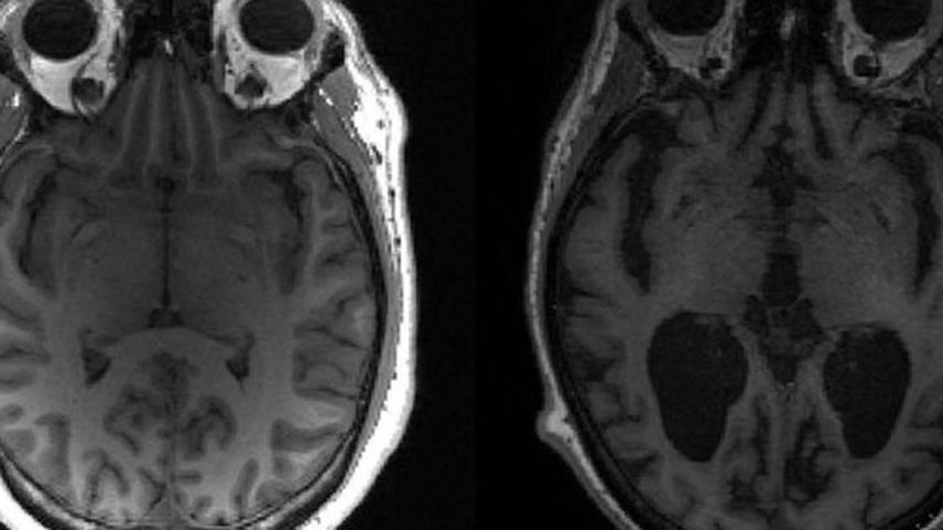 Cérebro saudável à esquerda e cérebro com Alzheimer à direita. (Foto: Reprodução)