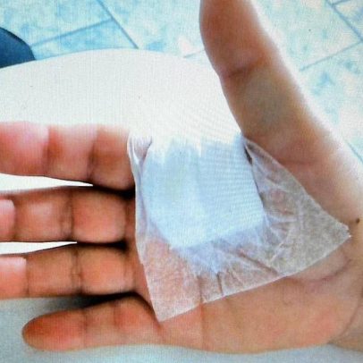Médico é condenado por realizar cirurgia no dedo errado de paciente em SP