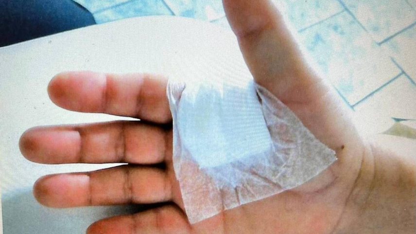 Curativo em paciente que acusa médico de ter operado dedo errado (Foto: Arquivo Pessoal)