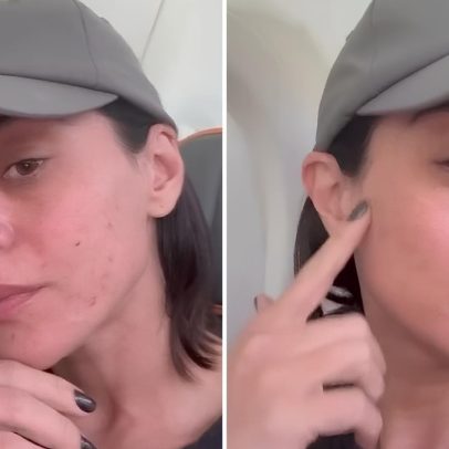 Rosácea afeta a saúde da atriz Carol Castro e gera preocupação entre fãs