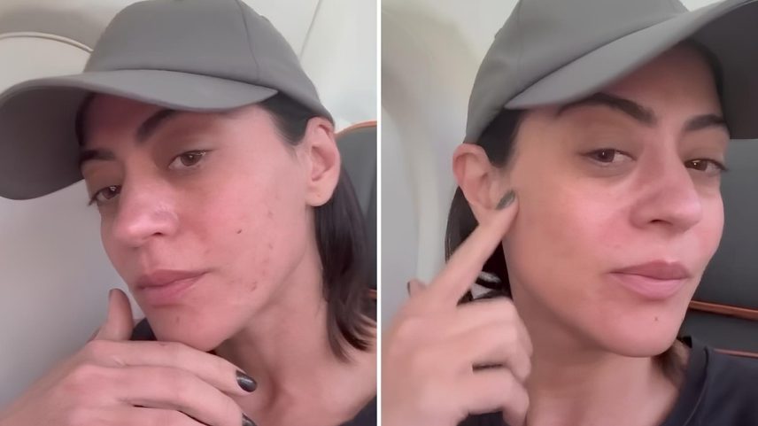Carol Castro mostra pele com rosácea (Foto: Reprodução/Redes Sociais)