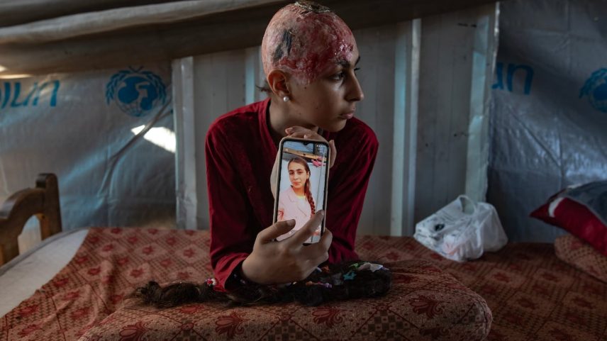 Hala Abu Dahlez, uma menina palestina de 12 anos, mostra uma foto sua tirada antes da lesão que sofreu quando um columpio metálico desabou sobre ela após um ataque aéreo israelense, em Al-Mawasi, Jan Yunis, no sul da faixa de Gaza, ontem. (Foto: HAITHAM IMAD/EFE)