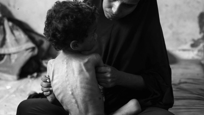 Mulher palestina segura filho que sofre de desnutrição, em campo de refugiados em Gaza (Foto: Omar Al-Qattaa - 23.jul.25/AFP)