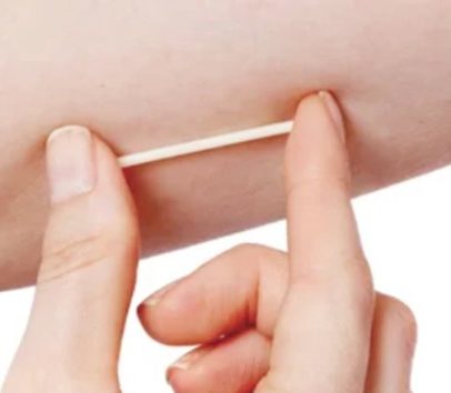 SUS disponibiliza novo implante contraceptivo moderno para a população