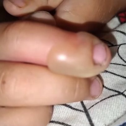 Criança sofre inchaço e bolha no dedo após contato com planta venenosa no Reino Unido