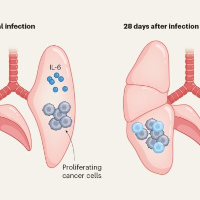 Inflamação em infecções virais pode ativar células cancerígenas adormecidas