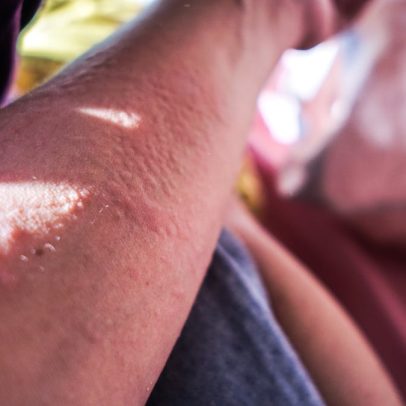 Entenda a alergia ao sol no verão e descubra como tratá-la efetivamente