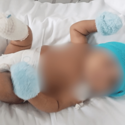 Bebê de 2 meses perde pé após complicações de bronquiolite e mãe denuncia erro médico