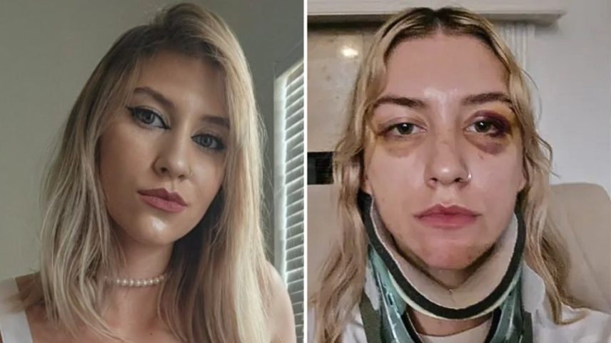 Anne Leigh McKenzie publicou foto e relato sobre agressão na internet (Foto: Reprodução/Redes Sociais - Reprodução/gofundme)