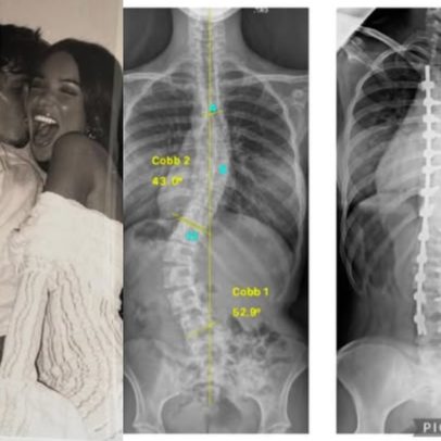 Nora dos Beckham relata 'inferno absoluto' após cirurgia na coluna e se declara a Cruz