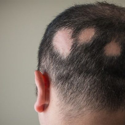 Alopecia areata gera debates sobre a necessidade de diretrizes mais eficazes