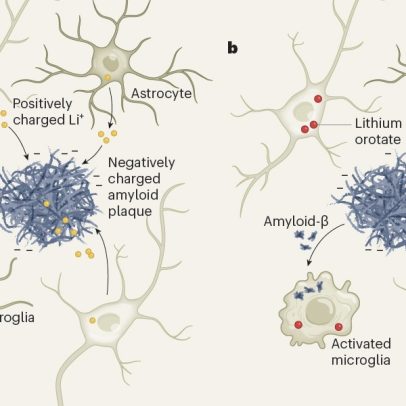 Deficiência de lítio pode estar ligada ao desenvolvimento da doença de Alzheimer