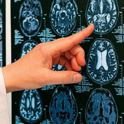 Pesquisadores desenvolvem modelo 3D para monitorar metástase cerebral em tempo real