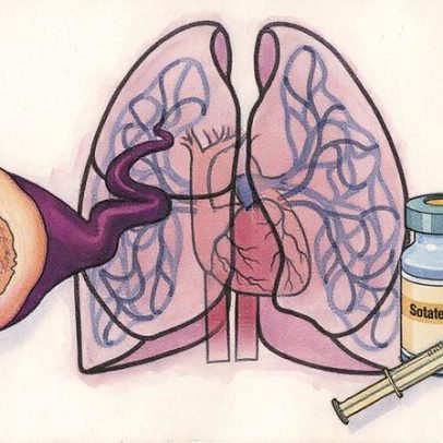 Novo tratamento revolucionário promete avanços no combate à hipertensão arterial pulmonar
