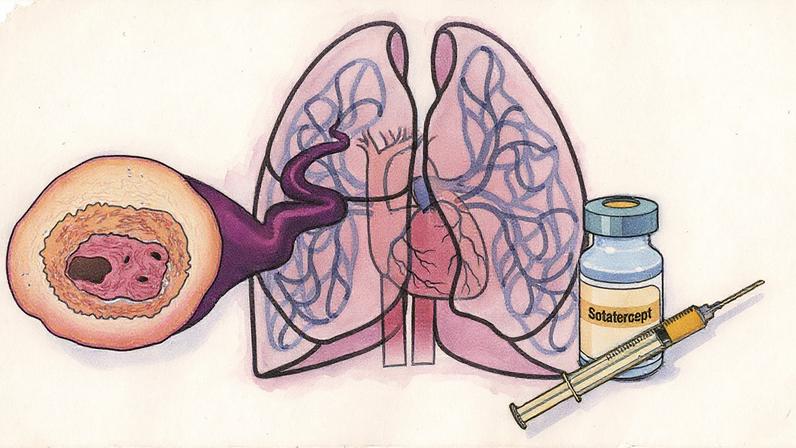 Desenho do pulmão com destaque para um vaso sanguíneo afetado pela doença. Ao lado está o frasco de um medicamento e uma seringa (Foto: USP Imagens)