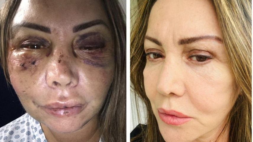 Elaine Caparroz quando foi agredida e atualmente: sequelas e tratamento (Foto: Reprodução)