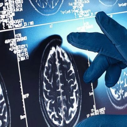 Lítio pode revolucionar tratamento do Alzheimer, aponta pesquisa de Harvard