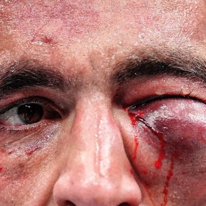 Lutador sofre inchaço no olho após luta intensa e chama atenção no UFC