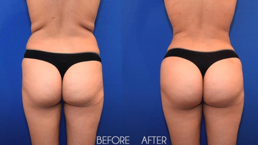 Antes e depois de cirurgia do 'bumbum brasileiro' feita nos EUA (Foto: Reprodução)