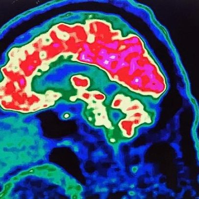 O aquecimento global prejudica a saúde mental e o funcionamento cerebral humano