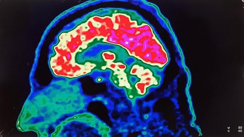 Há condições neurológicas que são agravadas pelo aumento da temperatura (Foto: FRED TANNEAU/AFP via Getty Images)