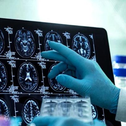 Tecnologia avança para aprimorar diagnósticos na psiquiatria moderna