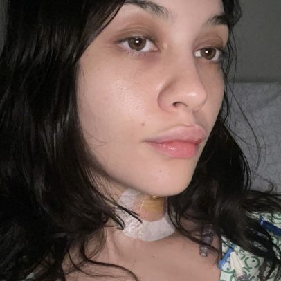 Jovem de 26 anos supera câncer no pulmão com cirurgia e entra em remissão