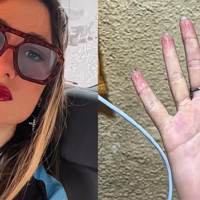 Bombeiros resgatam mulher com dedo preso em anel após inchaço intenso