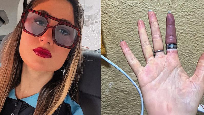 O dedo da jovem estava inchado (Foto: Reprodução/TikTok)