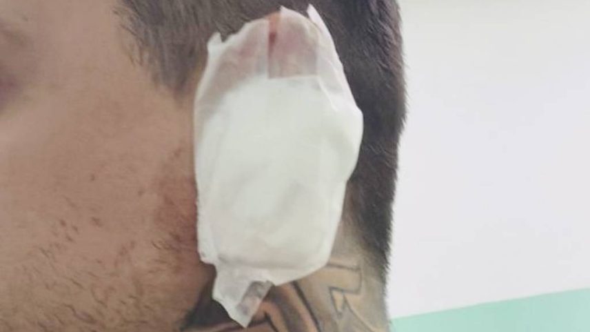 Victor Alschefsky com curativo na orelha esquerda, após sofrer ataque de gavião em Santos, no litoral paulista (Foto: Arquivo pessoal)