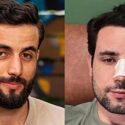 Rinoplastia de Matteus Amaral revela motivos estéticos e de saúde da cirurgia