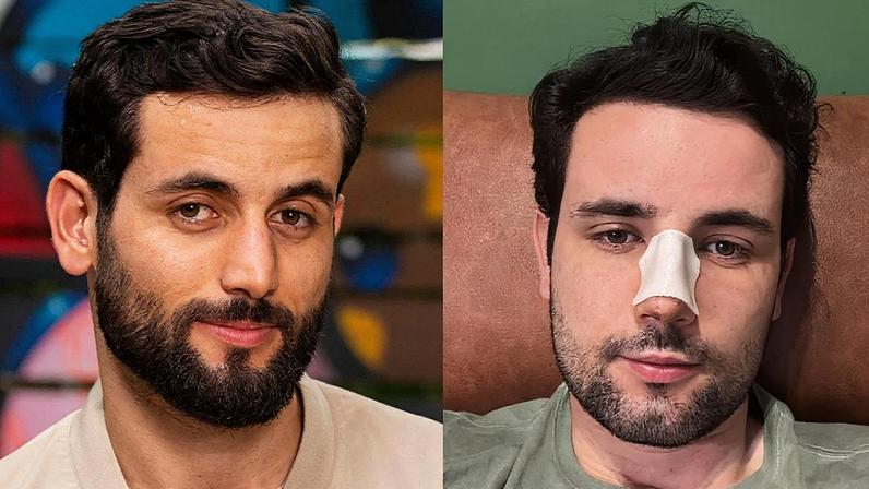 Cirurgia no nariz de Matteus Amaral alia estética e correção de problemas respiratórios (Foto: Divulgação TV Globo/Instagram)